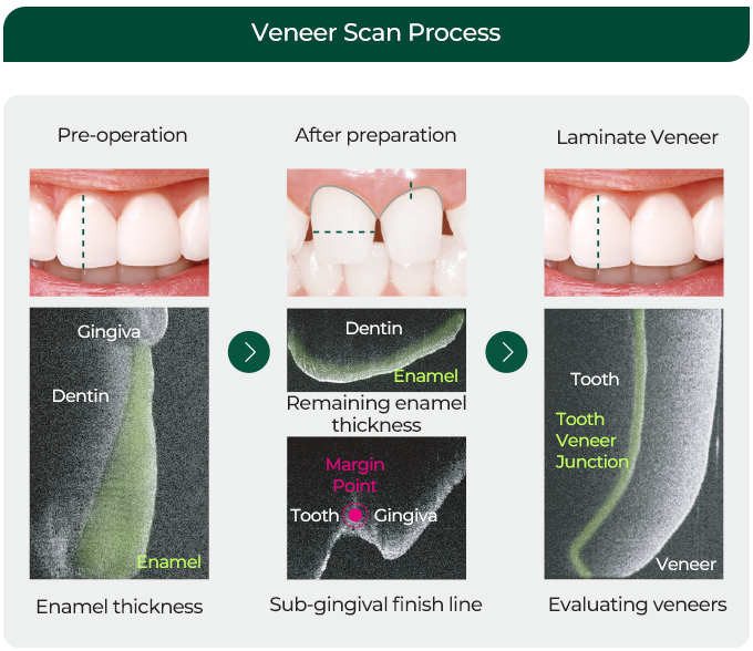 veneer Scan Process / Pre-operation / Gingiva / Dentin / Enamel / Enamel thickness / After preparation / Dentin / Enamel / Remaining enamel thickness / Margin Point / Tooth / Gingiva / Sub-gingival finish ling / Laminate Veneer / Tooth / Tooth Veneer Junction / Veneer / Evaluating Veneers
