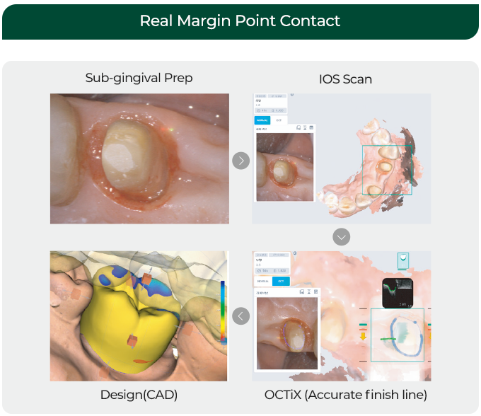 Real Margin Point Contact / Sub-gingival Prep / Design(CAD) / IOS Scan / OCT Scan(Accurate finish line)