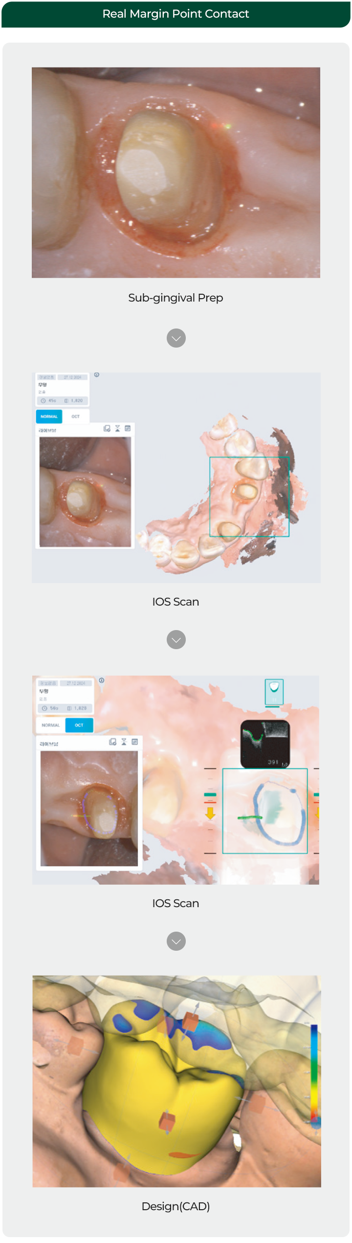 Real Margin Point Contact / Sub-gingival Prep / Design(CAD) / IOS Scan / OCT Scan(Accurate finish line)